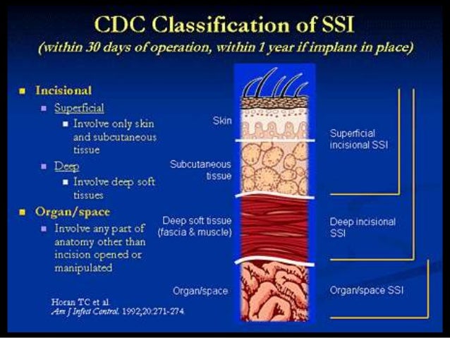 Prevention of Surgical Site Infection