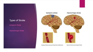 Prevention of Stroke.pptx