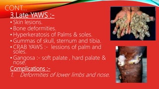 Prevention Of Yaws Roge Ppt PPTX Prevention Of Yaws Roge Ppt PPTX