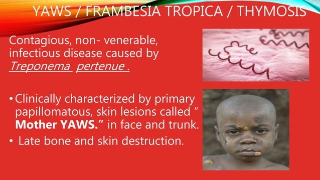 Prevention Of Yaws Roge Ppt PPT Prevention Of Yaws Roge Ppt PPT