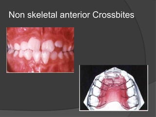Non skeletal anterior Crossbites
 