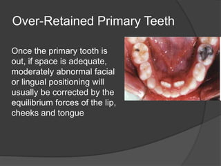 Over-Retained Primary Teeth

Once the primary tooth is
out, if space is adequate,
moderately abnormal facial
or lingual positioning will
usually be corrected by the
equilibrium forces of the lip,
cheeks and tongue
 