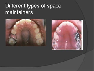 Different types of space
maintainers
 