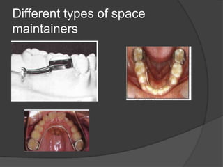 Different types of space
maintainers
 