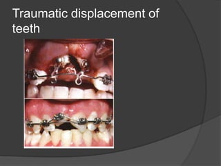Traumatic displacement of
teeth
 