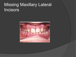Missing Maxillary Lateral
Incisors
 