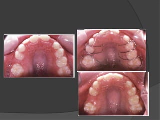 Preventive and interceptive orthodontics