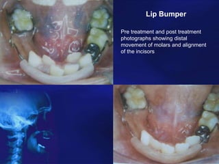 Preventive and Interceptive Orthodontics in Pediactric Dentistry | PPTX