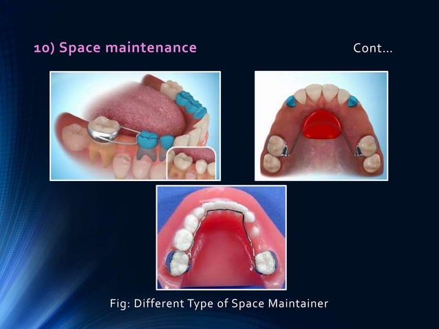 Preventive and interceptive orthodontics (basic) | PPTX
