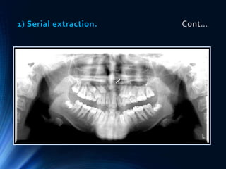 Preventive and interceptive orthodontics (basic) | PPTX