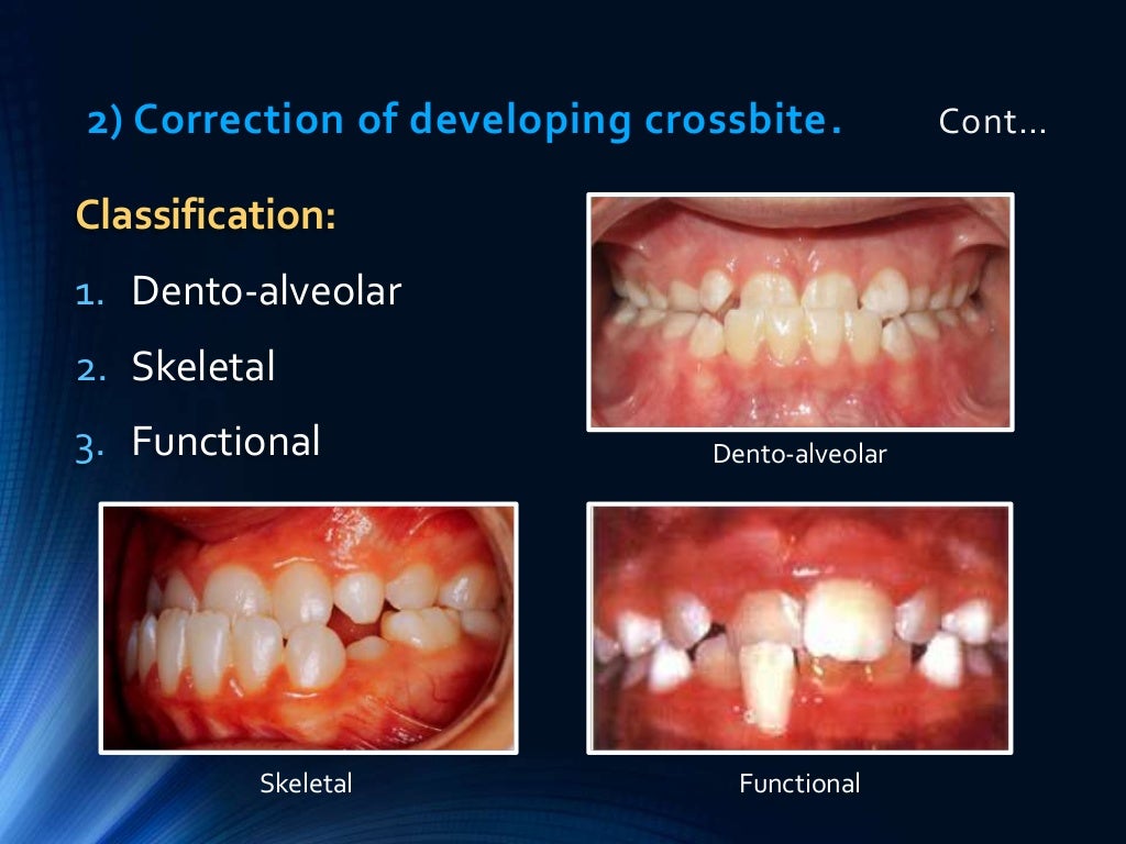 Preventive and interceptive orthodontics (basic)