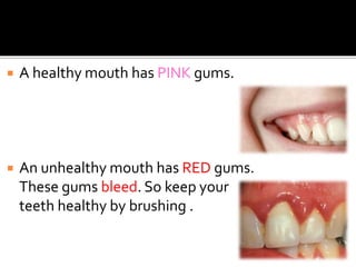  A healthy mouth has PINK gums.
 An unhealthy mouth has RED gums.
These gums bleed. So keep your
teeth healthy by brushing .
 