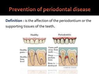 Definition : is the affection of the periodontium or the
supporting tissues of the teeth.
 