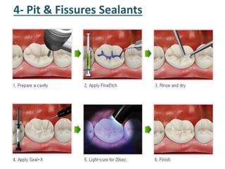 4- Pit & Fissures Sealants
 