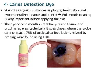 4- Caries Detection Dye
• Stain the Organic substances as plaque, food debris and
hypomineralized enamel and dentin  Full mouth cleaning
is very important before applying the dye
• The dye once in mouth enters the pits and fissure and
proximal spaces, technically it goes places where the probe
can not reach. 75% of occlusal carious lesions missed by
probing were found using CDD
 