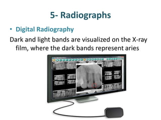 5- Radiographs
• Digital Radiography
Dark and light bands are visualized on the X-ray
film, where the dark bands represent aries
 