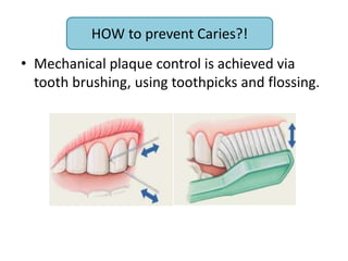 How to prevent caries?
• Mechanical plaque control is achieved via
tooth brushing, using toothpicks and flossing.
HOW to prevent Caries?!
 