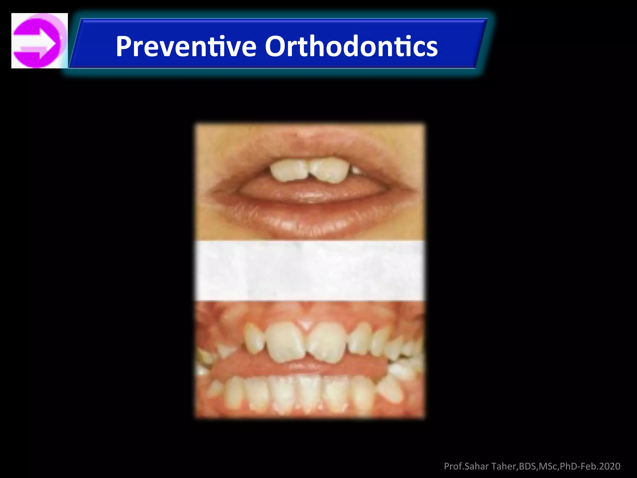 Preventive & Interceptive Orthodontics-Prof.Sahar Taher, Feb.2020 | PDF
