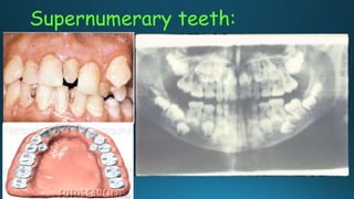 Supernumerary teeth:
 