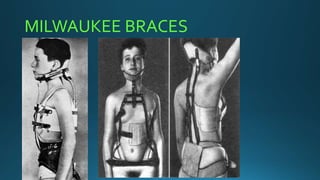 MILWAUKEE BRACES
 