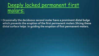Deeply locked permanent first
molars:
 