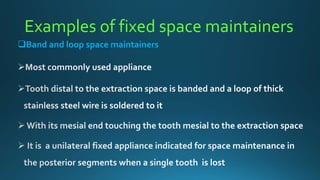 Examples of fixed space maintainers
Band and loop space maintainers
 