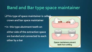 Band and Bar type space maintainer
 