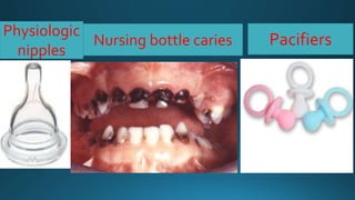 Physiologic
nipples
PacifiersNursing bottle caries
 