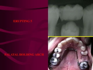 ERUPTING 5
PALATAL HOLDING ARCH
 