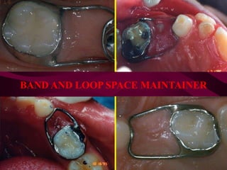 BAND AND LOOP SPACE MAINTAINER
 