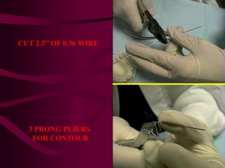 CUT 2.5’’ OF 0.36 WIRE
3 PRONG PLIERS
FOR CONTOUR
 
