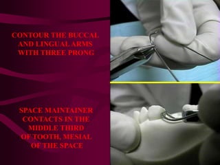 CONTOUR THE BUCCAL
AND LINGUAL ARMS
WITH THREE PRONG
SPACE MAINTAINER
CONTACTS IN THE
MIDDLE THIRD
OF TOOTH, MESIAL
OF THE SPACE
 