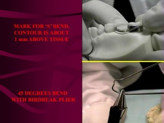 MARK FOR ‘S’ BEND,
CONTOUR IS ABOUT
1 mm ABOVE TISSUE
45 DEGREES BEND
WITH BIRDBEAK PLIER
 
