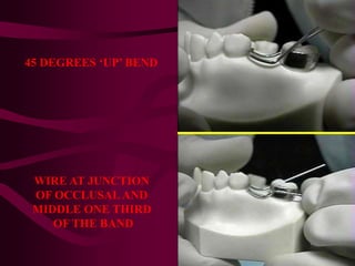 45 DEGREES ‘UP’ BEND
WIRE AT JUNCTION
OF OCCLUSAL AND
MIDDLE ONE THIRD
OF THE BAND
 