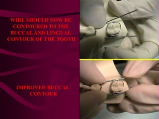 WIRE SHOULD NOW BE
CONTOURED TO THE
BUCCAL AND LINGUAL
CONTOUR OF THE TOOTH
IMPROVED BUCCAL
CONTOUR
 