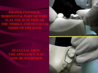 PROPER CONTOUR,
HORIZONTAL PART OF WIRE
IS AT THE JUNCTION OF
THE MIDDLE AND OCCLUSAL
THIRD OF THE BAND
OCCLUSAL VIEW,
THE APPLIANCE MAY
NOW BE SOLDERED
 