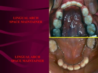 LINGUALARCH
SPACE MAINTAINER
LINGUALARCH
SPACE MAINTAINER
 