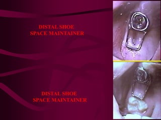 DISTAL SHOE
SPACE MAINTAINER
DISTAL SHOE
SPACE MAINTAINER
 