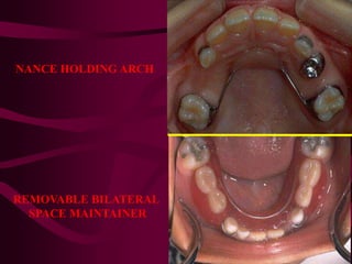 NANCE HOLDING ARCH
REMOVABLE BILATERAL
SPACE MAINTAINER
 