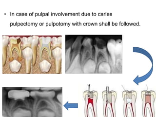 • In case of pulpal involvement due to caries
pulpectomy or pulpotomy with crown shall be followed.
 