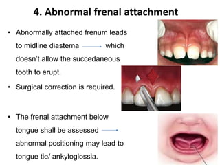 4. Abnormal frenal attachment
• Abnormally attached frenum leads
to midline diastema which
doesn’t allow the succedaneous
tooth to erupt.
• Surgical correction is required.
• The frenal attachment below
tongue shall be assessed
abnormal positioning may lead to
tongue tie/ ankyloglossia.
 