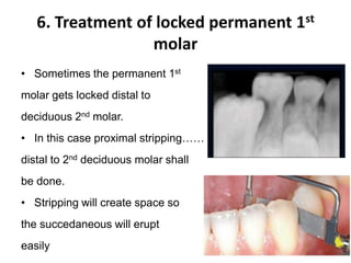 6. Treatment of locked permanent 1st
molar
• Sometimes the permanent 1st
molar gets locked distal to
deciduous 2nd molar.
• In this case proximal stripping……
distal to 2nd deciduous molar shall
be done.
• Stripping will create space so
the succedaneous will erupt
easily
 