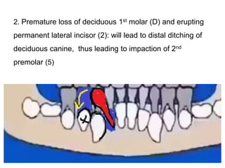 2. Premature loss of deciduous 1st molar (D) and erupting
permanent lateral incisor (2): will lead to distal ditching of
deciduous canine, thus leading to impaction of 2nd
premolar (5)
 