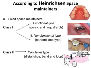 According to Heinrichsen Space
maintainers
a. Fixed space maintainers:
i. Functional type
Class I (pontic and lingual arch)
ii. Non functional type
(bar and loop type)
Class II Cantilever type
(distal shoe, band and loop)
 