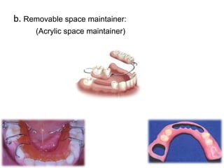 b. Removable space maintainer:
(Acrylic space maintainer)
 