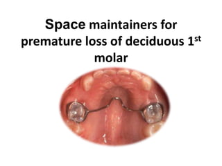 Space maintainers for
premature loss of deciduous 1st
molar
 