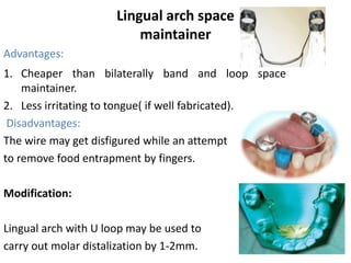 Lingual arch space
maintainer
Advantages:
1. Cheaper than bilaterally band and loop space
maintainer.
2. Less irritating to tongue( if well fabricated).
Disadvantages:
The wire may get disfigured while an attempt
to remove food entrapment by fingers.
Modification:
Lingual arch with U loop may be used to
carry out molar distalization by 1-2mm.
 