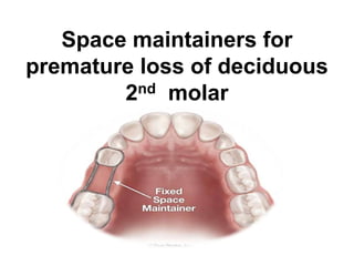 Space maintainers for
premature loss of deciduous
2nd molar
 