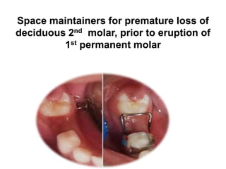 Space maintainers for premature loss of
deciduous 2nd molar, prior to eruption of
1st permanent molar
 