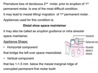 Premature loss of deciduous 2nd molar, prior to eruption of 1st
permanent molar, Is one of the most difficult condition.
It may lead to mesial tilting/ migration of 1st permanent molar .
Appliances used for this condition is:
Distal shoe space maintainer
it may also be called as eruption guidance or intra alveolar
space maintainer.
Appliance Shape:
• Horizontal component
that bridge the left over space mesiodistal.
• Vertical component
that lies 1-1.5 mm below the mesial marginal ridge of
unerupted permanent first molar tooth
 